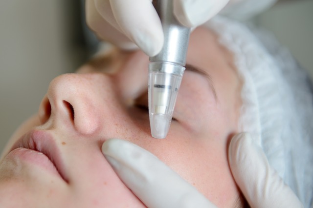 Read more about the article An Insight Into Microdermabrasion